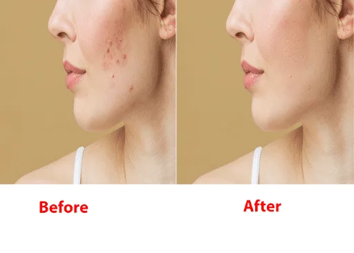 Skin retouching